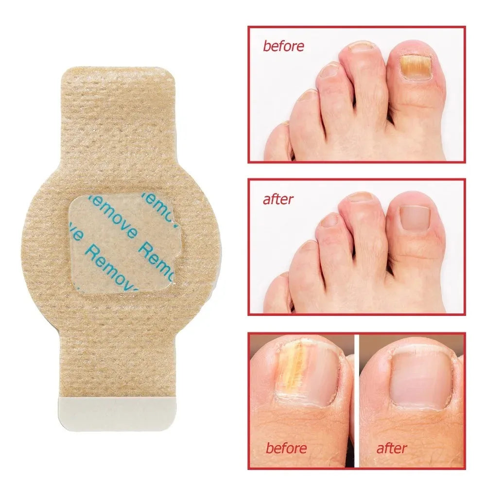 Nail Care Patches for Fungus-Prone & Ingrown Toenails