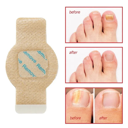 Nail Care Patches for Fungus-Prone & Ingrown Toenails